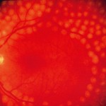 retine-diabete-panphoto-coagulation